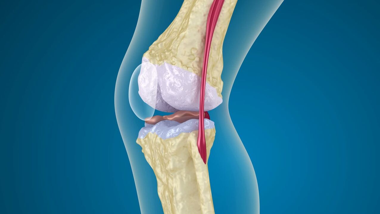 destroy the knee joint with paresis