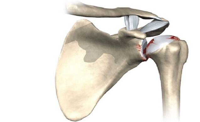 shoulder joint injury due to arthritis