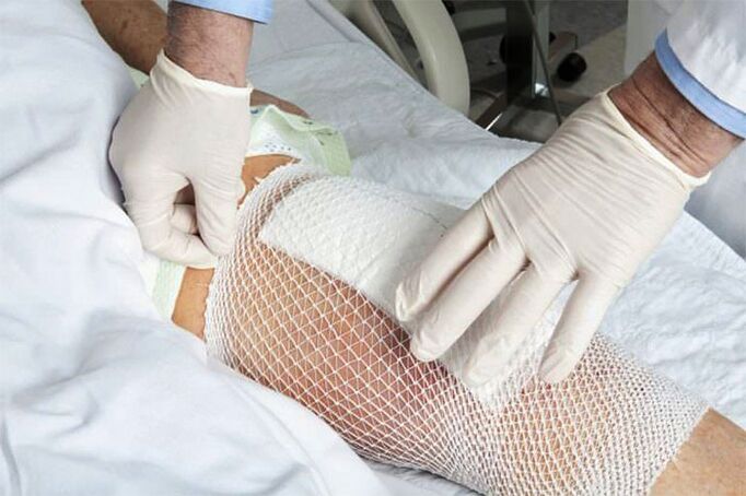 Compression therapy for arthritis of the knee joint