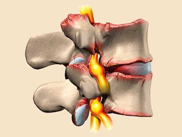 Spinal trauma in thoracic osteoarthritis