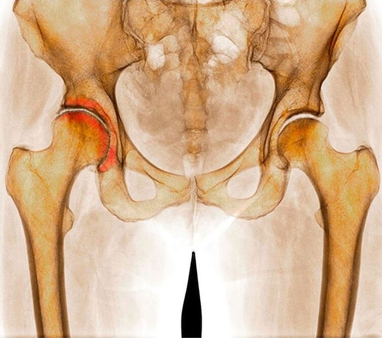 hip arthritis is the cause of pain