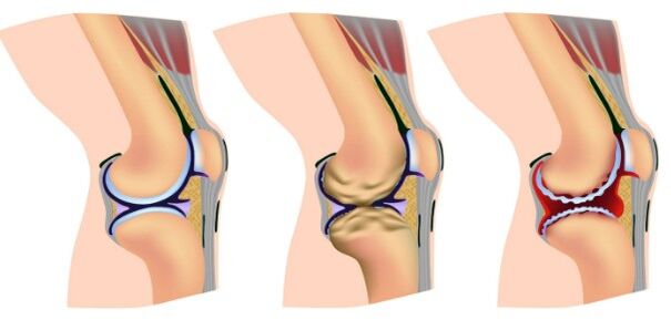 The stages of deformation of the knee joint