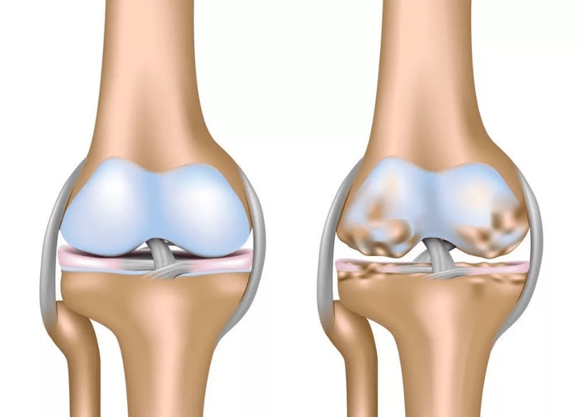 Arthritis