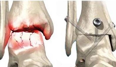 Treatment of knee arthritis surgery