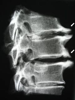 Osteoporosis of the cervical spine causes neck pain