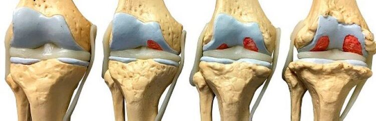 Stages of knee arthritis