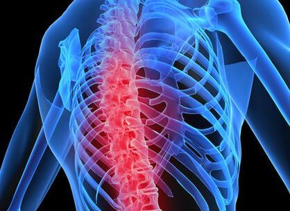 Osteoarthritis of the thoracic spine
