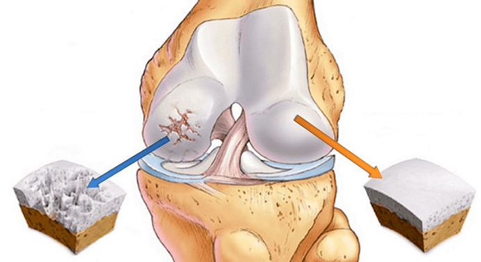 healthy cartilage and cartilage affected by arthritis