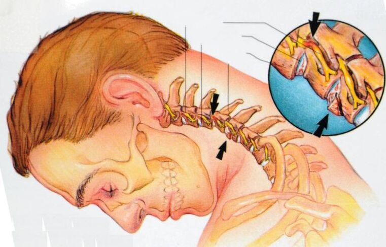 What happens with cervical spondylosis