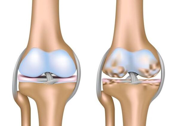 arthritis