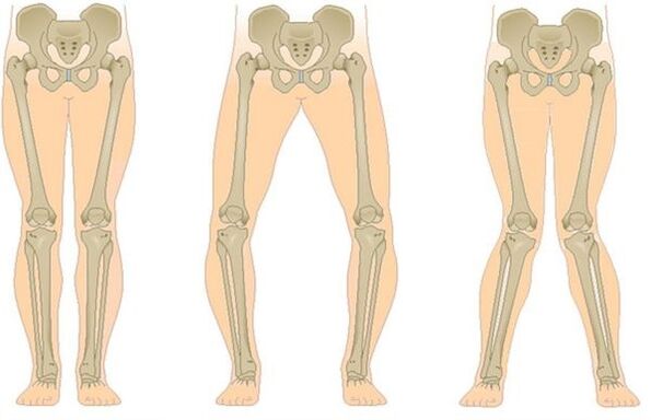 types of joint diseases
