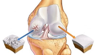 Reasons for the development of arthritis