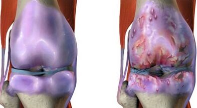 The main difference of arthritis and joint disease