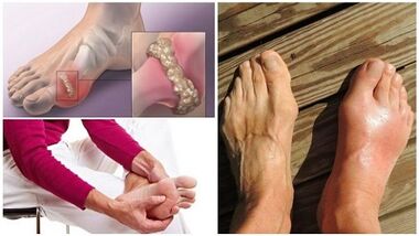 What is arthritis of joints