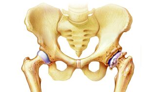 Why does degeneration of the hip joints occur